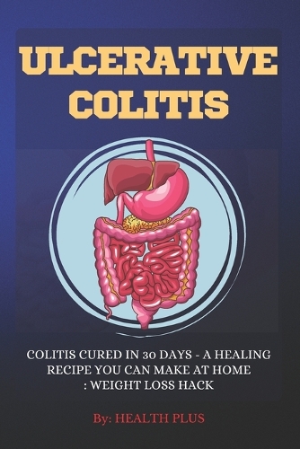 Ulcerative Colitis