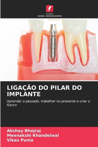 Ligação Do Pilar Do Implante