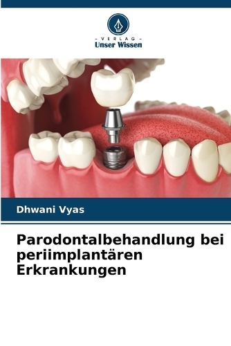 Parodontalbehandlung bei periimplantären Erkrankungen