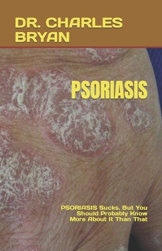 Psoriasis