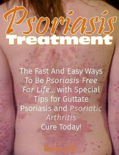 Psoriasis Treatment: The Fast and Easy Ways to Be Psoriasis Free for Life... With Special Tips for Guttate Psoriasis and Psoriatic Arthritis Cure Today!