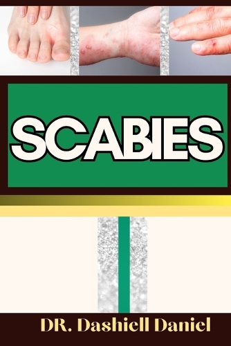 Scabies