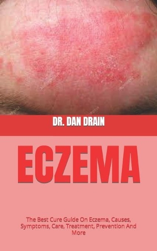Eczema