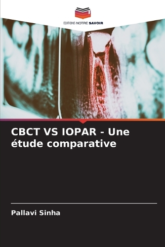 CBCT VS IOPAR - Une étude comparative