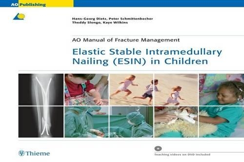 Elastic Stable Intramedullary Nailing (ESIN) in Children: (AO-Publishing)