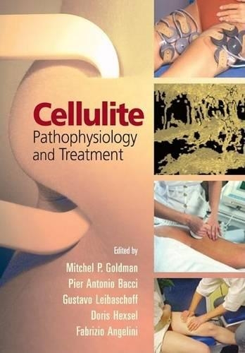 Cellulite: Pathophysiology and Treatment: (Basic and Clinical Dermatology)