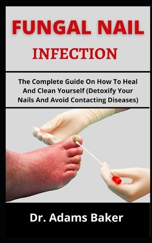 Fungal Nail Infection