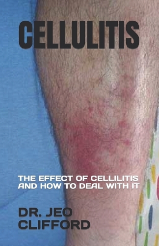 Cellulitis