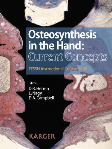 Osteosynthesis in the Hand: Current Concepts