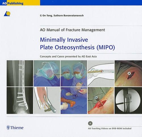 Minimally Invasive Plate Osteosynthesis (MIPO)
