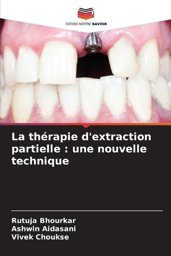 La thérapie d'extraction partielle: une nouvelle technique