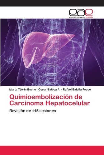 Quimioembolización de Carcinoma Hepatocelular