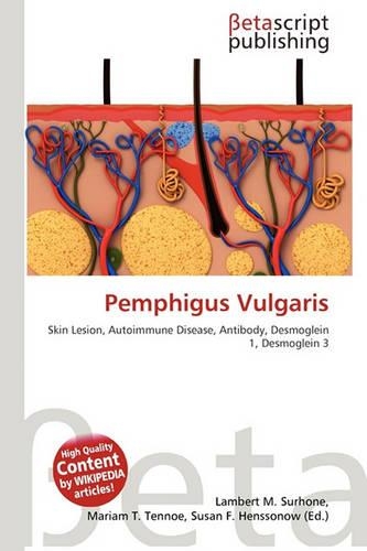 Pemphigus Vulgaris