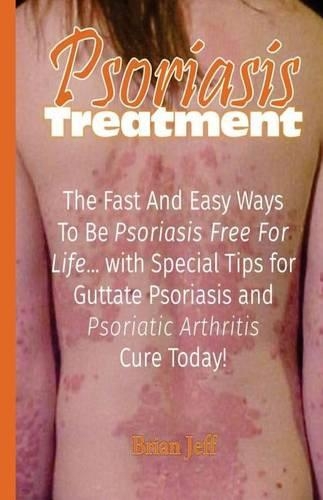 Psoriasis Treatment