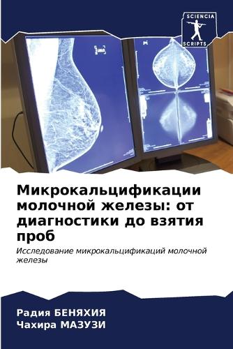 Микрокальцификации молочной железы: ?? ??????????? ?? ?????? ????