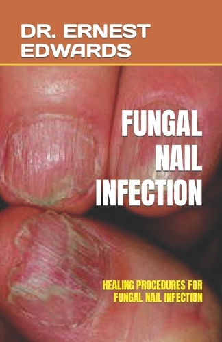Fungal Nail Infection