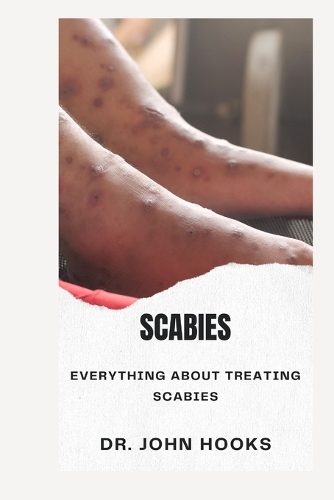 Scabies