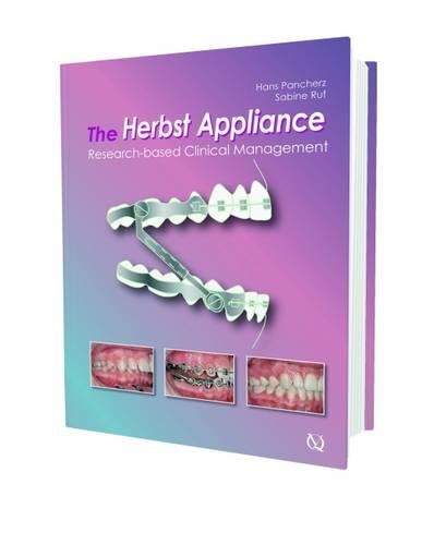 The Herbst Appliance: Research Based Clinical Management