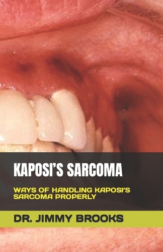 Kaposi's Sarcoma