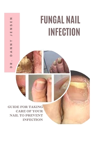Fungal Nail Infection