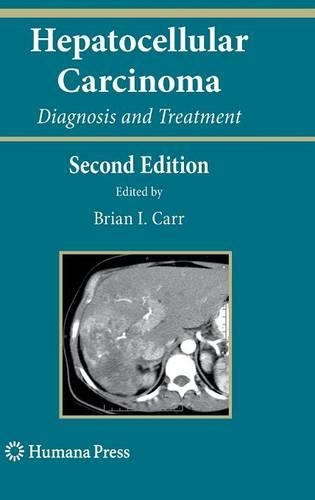 Hepatocellular Carcinoma