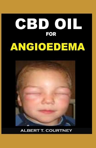 CBD Oil for Angioedema: The Simple Guide on How CBD Oil Works for Angioedema