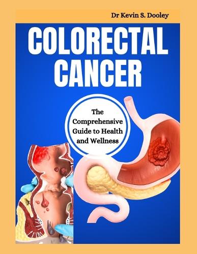 Colorectal Cancer