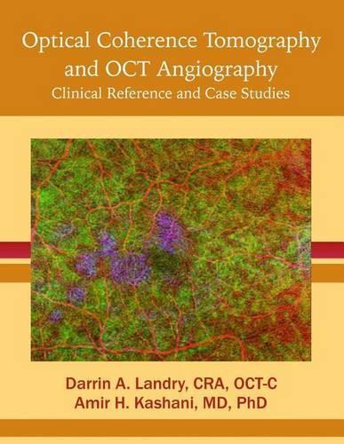 Optical Coherence Tomography and Oct Angiography