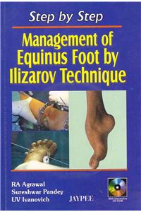 Step by Step: Management of Equinus Foot by Ilizarov Technique