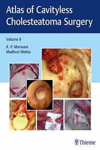 Atlas of Cavityless Cholesteatoma Surgery, Vol 2