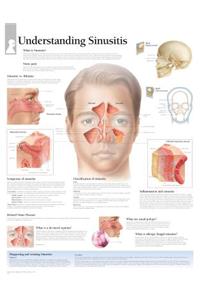 Understanding Sinusitis Laminated Poster