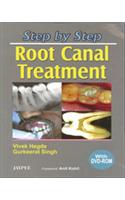 Step by Step: Root Canal Treatment