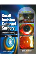 Small Incision Cataract Surgery (Manual Phaco)