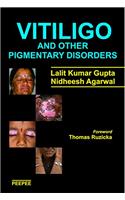 Vitiligo and Other Pigmentary Disorders